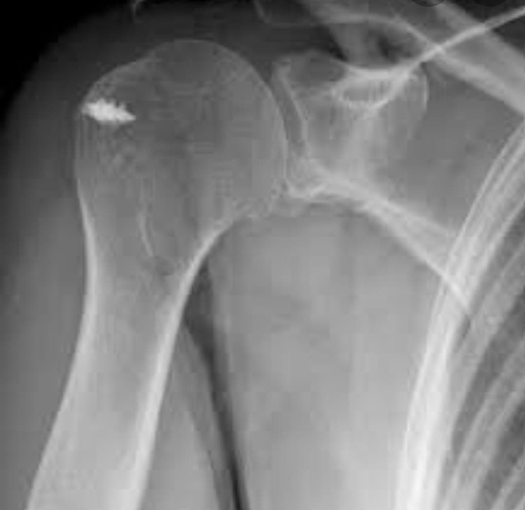 Orthopaedic X-ray scan 1 reviewed by Dr. Mayank Chauhan at Prakash Hospital, Noida