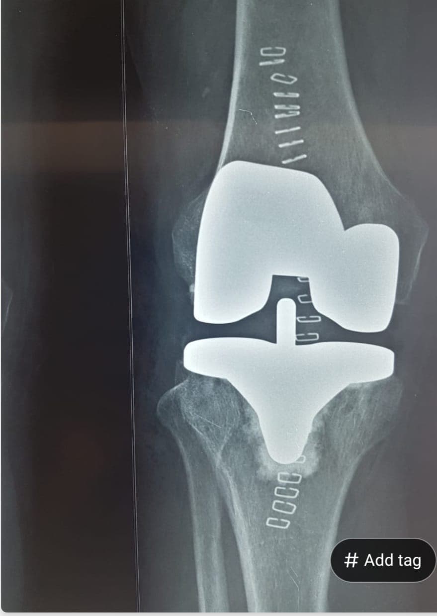 Orthopaedic X-ray scan 2 reviewed by Dr. Mayank Chauhan at Prakash Hospital, Noida