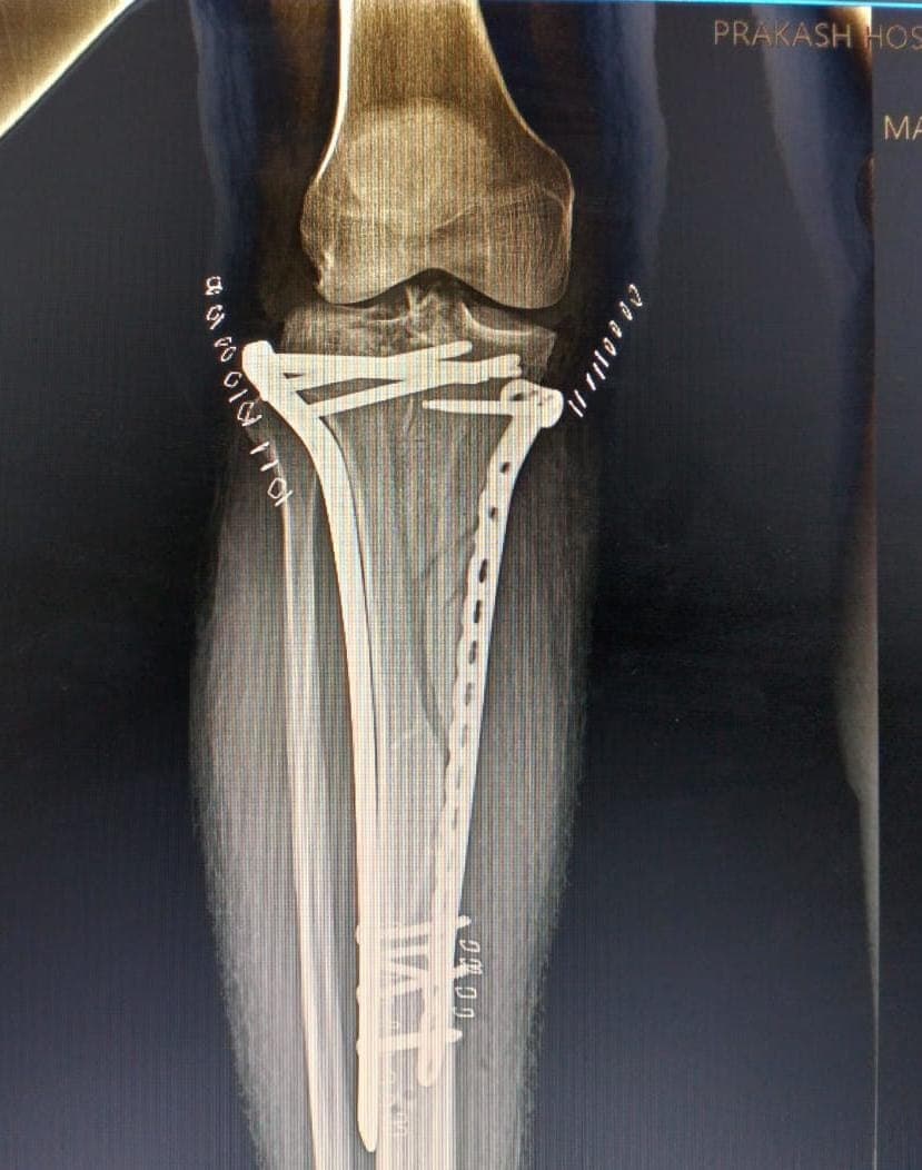Orthopaedic X-ray scan 3 reviewed by Dr. Mayank Chauhan at Prakash Hospital, Noida