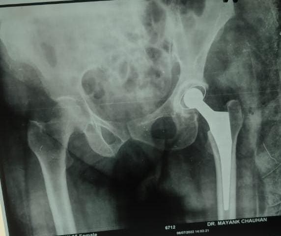Orthopaedic X-ray scan 4 reviewed by Dr. Mayank Chauhan at Prakash Hospital, Noida