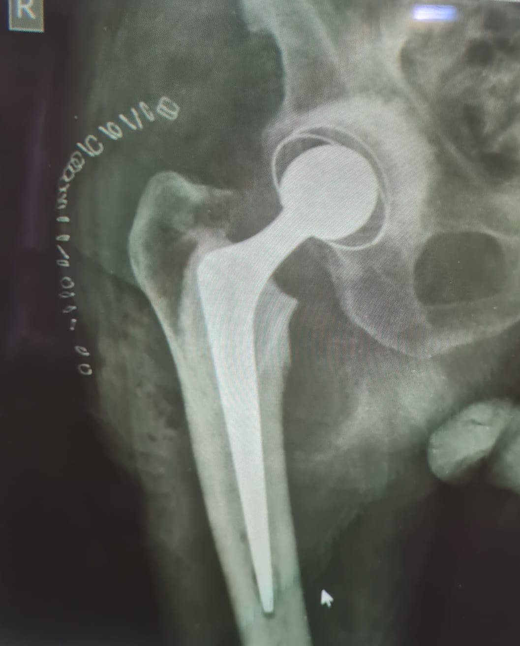 Orthopaedic X-ray scan 5 reviewed by Dr. Mayank Chauhan at Prakash Hospital, Noida