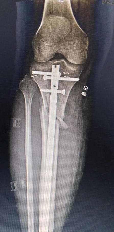Orthopaedic X-ray scan 6 reviewed by Dr. Mayank Chauhan at Prakash Hospital, Noida