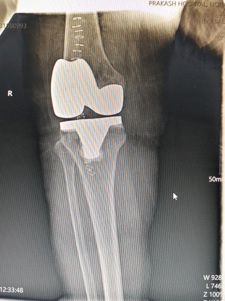 Orthopaedic X-ray scan 7 reviewed by Dr. Mayank Chauhan at Prakash Hospital, Noida