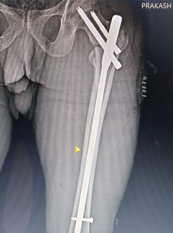 Orthopaedic X-ray scan 8 reviewed by Dr. Mayank Chauhan at Prakash Hospital, Noida