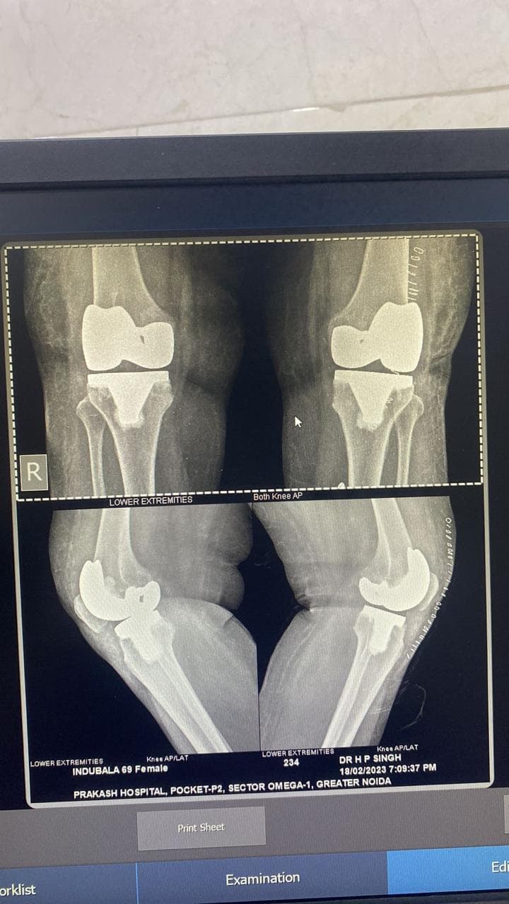 Joint and bone X-ray scan 1 used for orthopaedic diagnosis by Dr. Mayank Chauhan, Noida