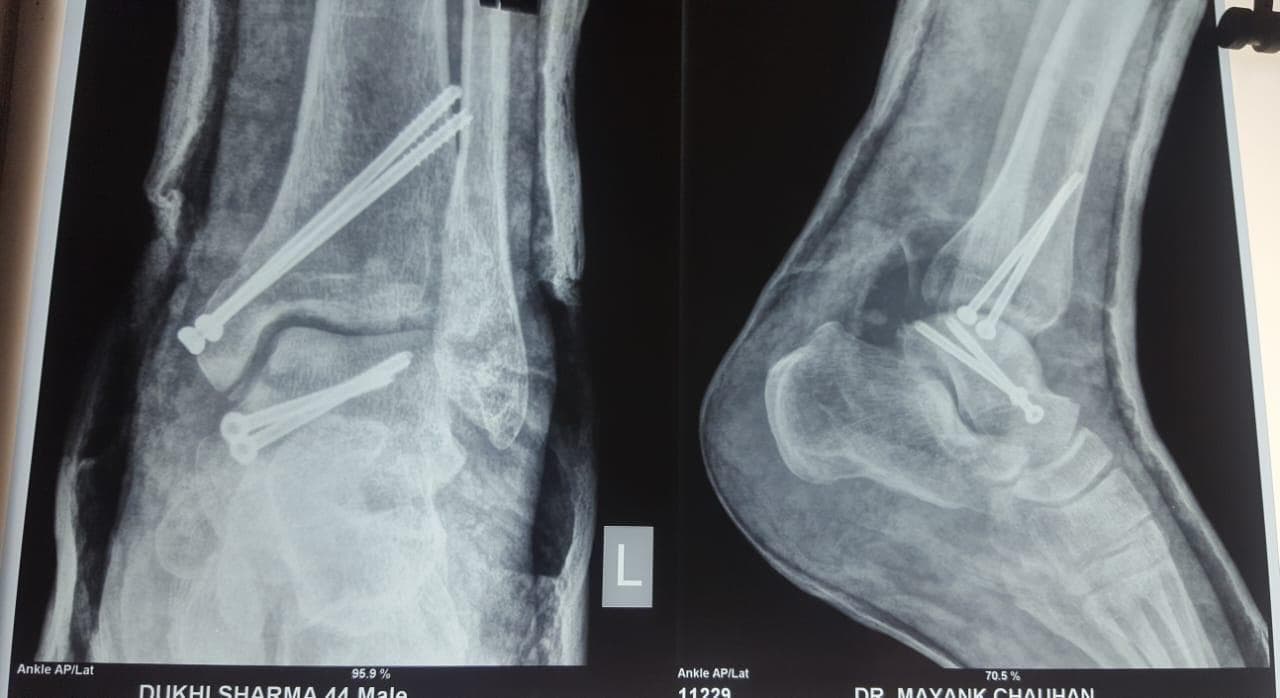 Joint and bone X-ray scan 11 used for orthopaedic diagnosis by Dr. Mayank Chauhan, Noida
