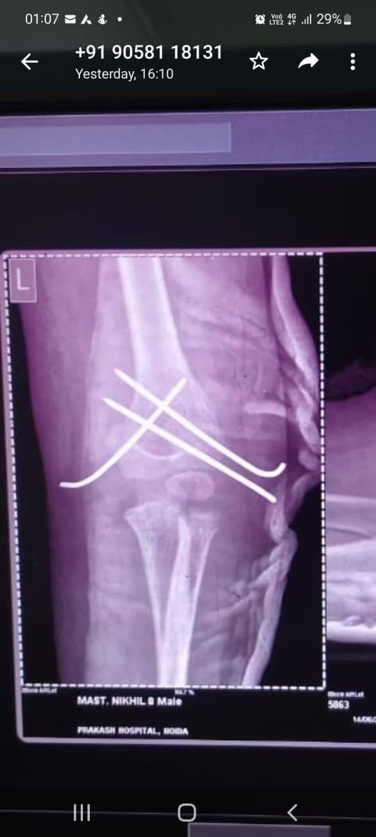 Joint and bone X-ray scan 13 used for orthopaedic diagnosis by Dr. Mayank Chauhan, Noida