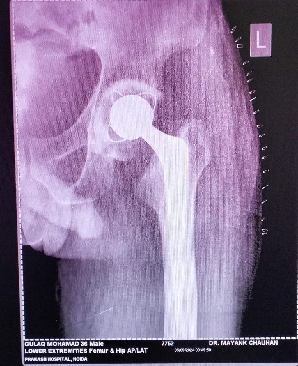 Joint and bone X-ray scan 2 used for orthopaedic diagnosis by Dr. Mayank Chauhan, Noida