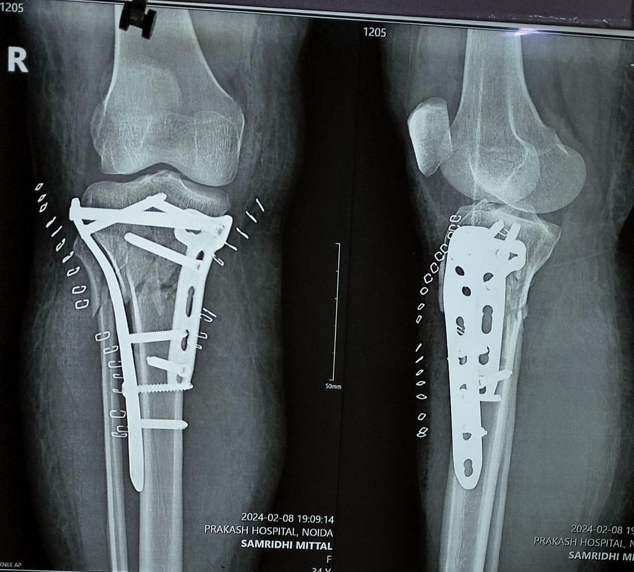 Joint and bone X-ray scan 3 used for orthopaedic diagnosis by Dr. Mayank Chauhan, Noida