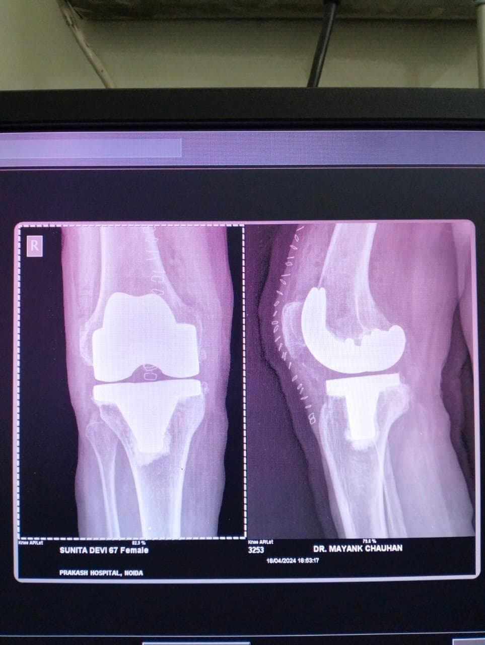 Joint and bone X-ray scan 4 used for orthopaedic diagnosis by Dr. Mayank Chauhan, Noida