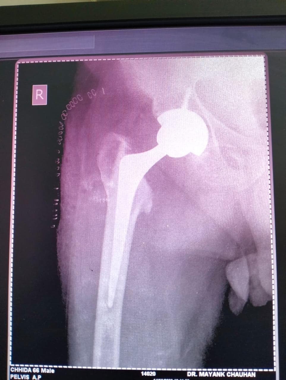 Joint and bone X-ray scan 5 used for orthopaedic diagnosis by Dr. Mayank Chauhan, Noida