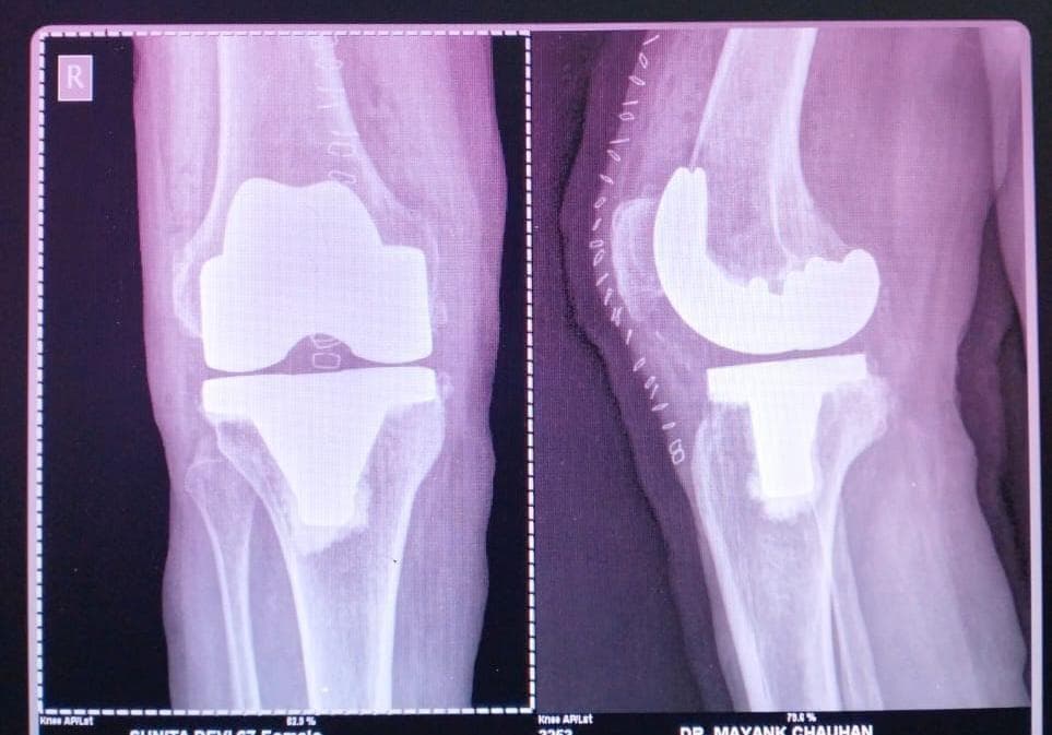 Joint and bone X-ray scan 6 used for orthopaedic diagnosis by Dr. Mayank Chauhan, Noida