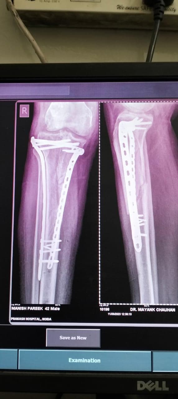 Joint and bone X-ray scan 7 used for orthopaedic diagnosis by Dr. Mayank Chauhan, Noida