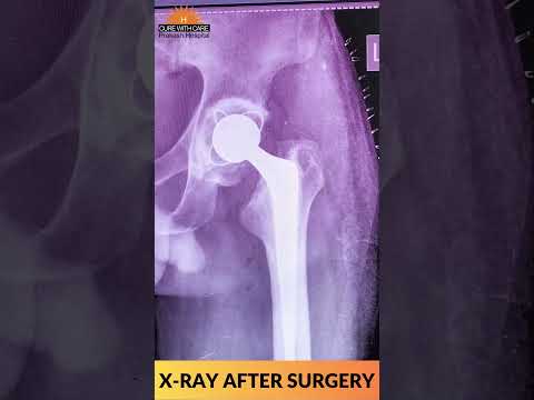 Complex Total Hip Replacement: