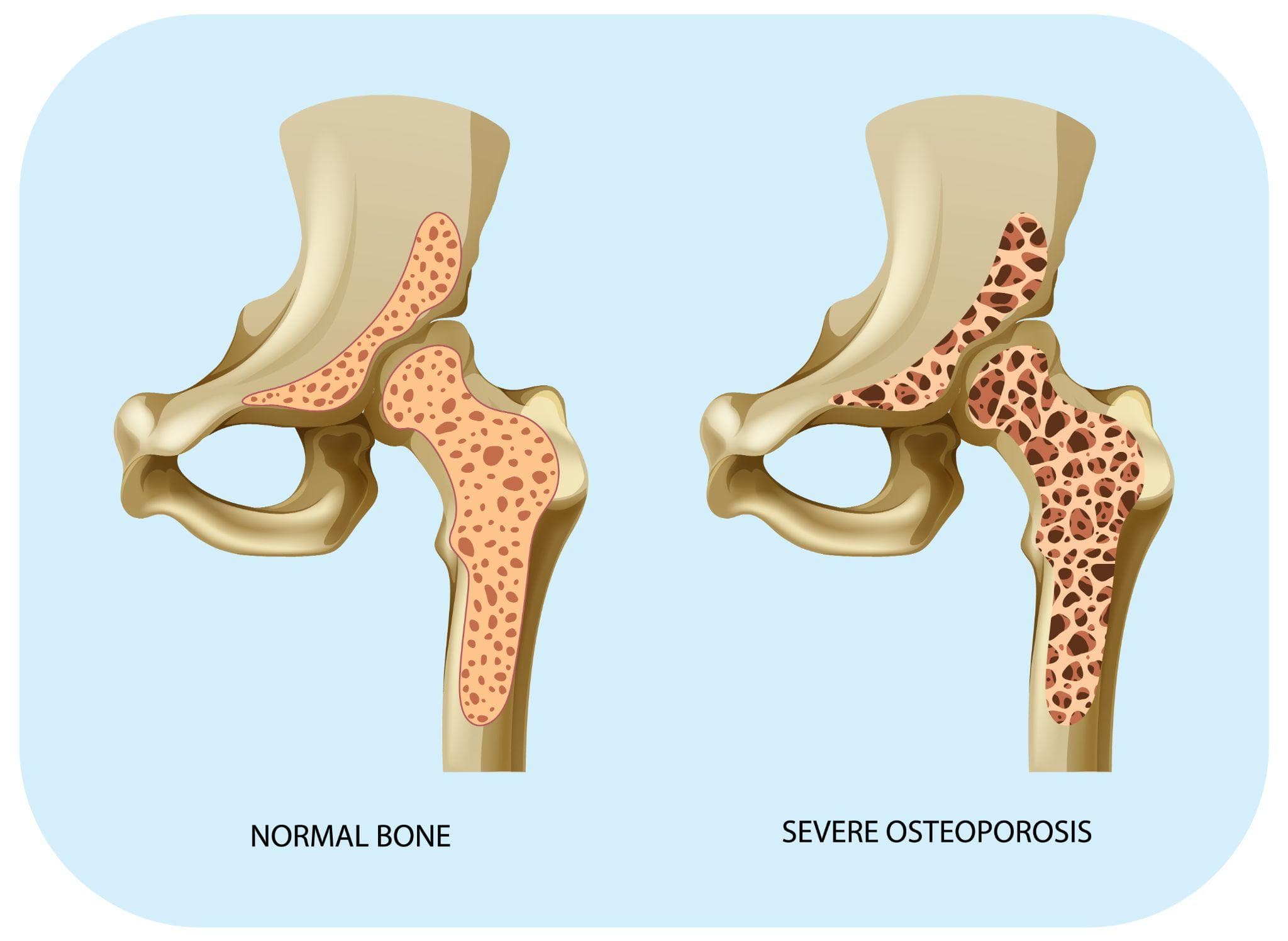 Osteoporosis Treatment — Medications, Lifestyle, and When Surgery Is Needed