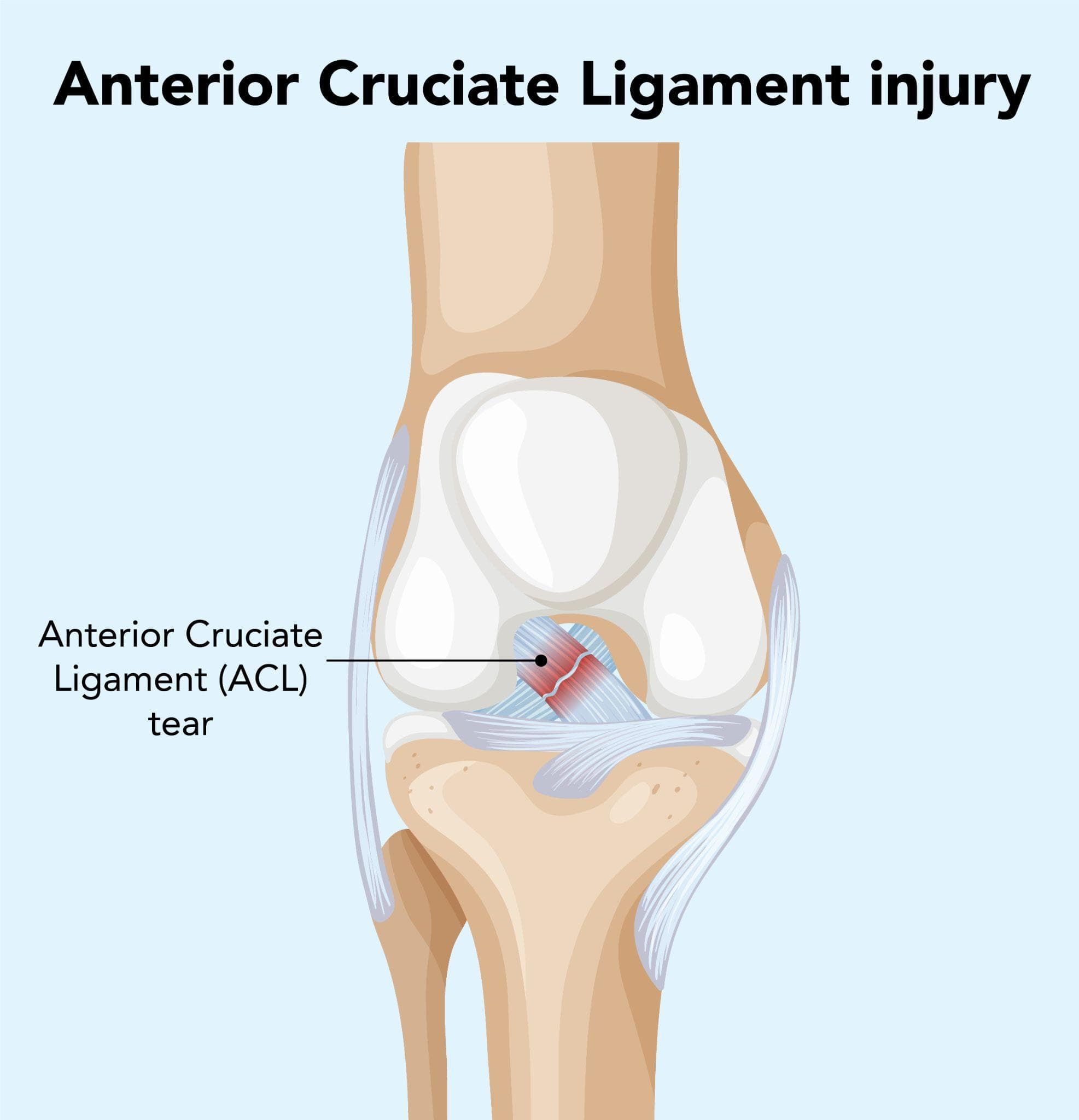 ACL, PCL & Ligament Reconstruction: What To Expect
