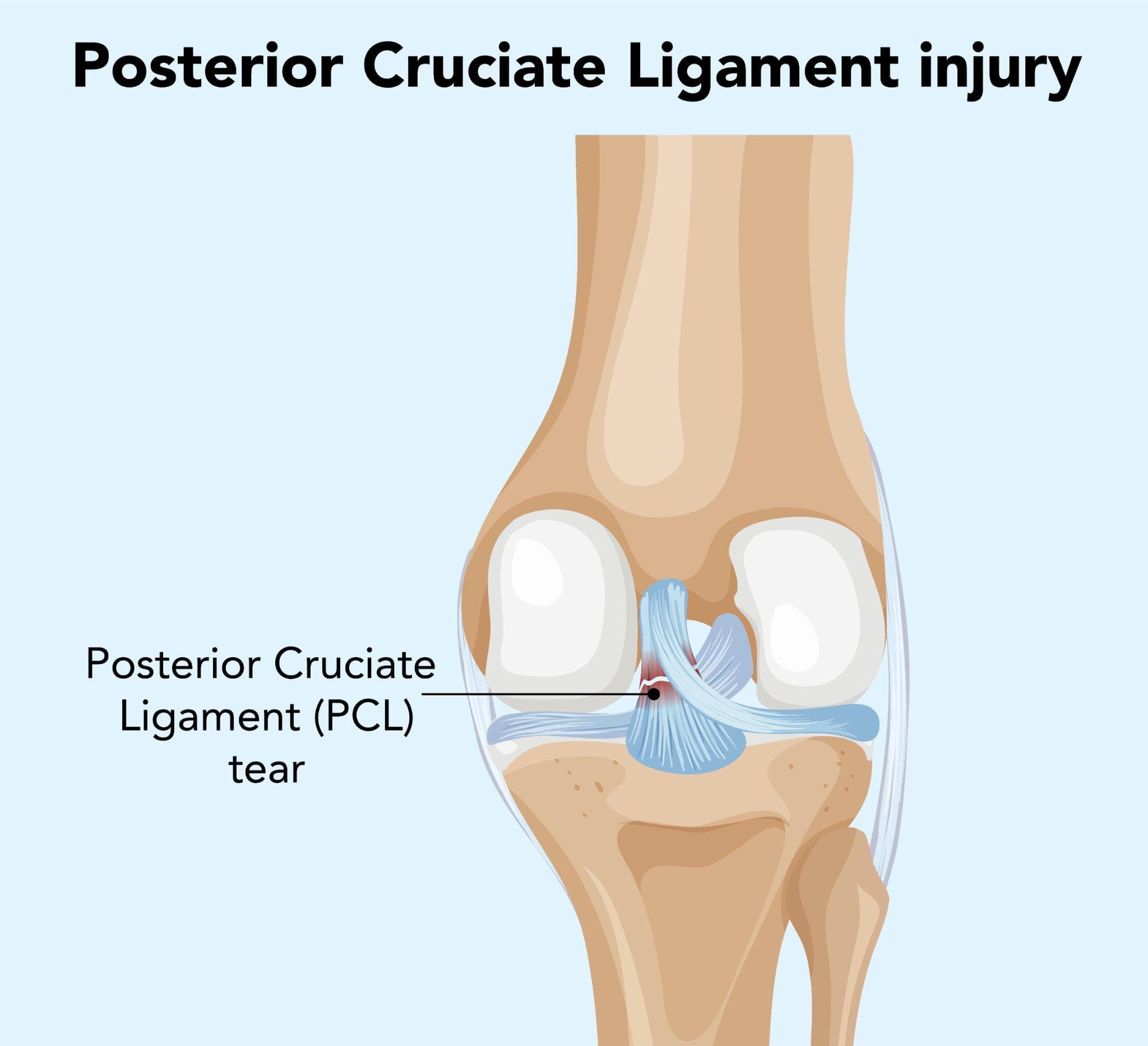 PCL Tear - Causes, Symptoms, Diagnosis, And Treatment