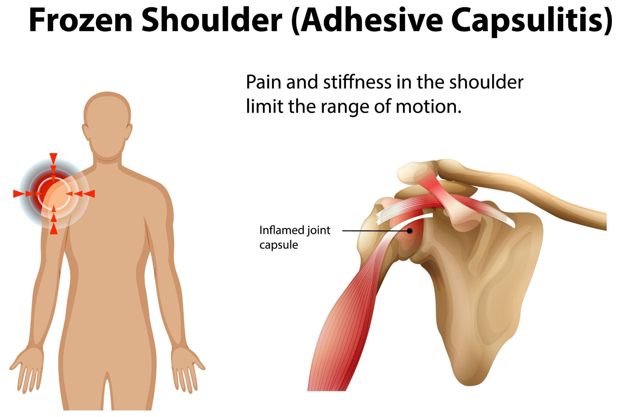 Understanding Frozen Shoulder And Its Modern Treatment