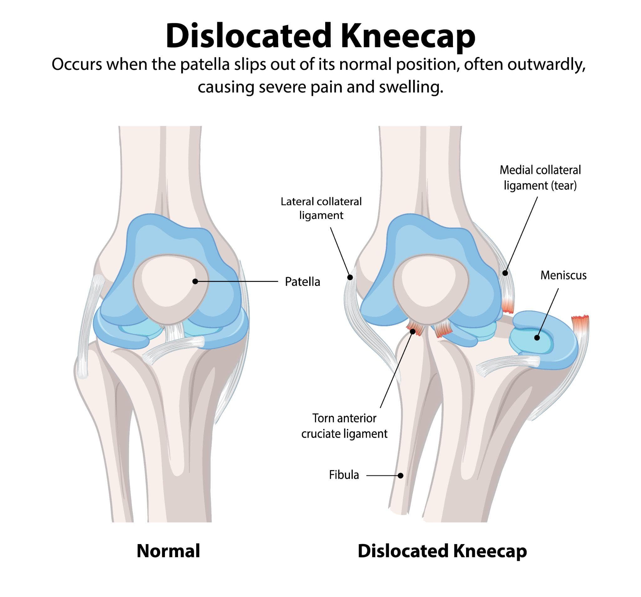 A diagram showing the difference between a normal and dislocated kneecap, and has marked all the important bone parts around it.