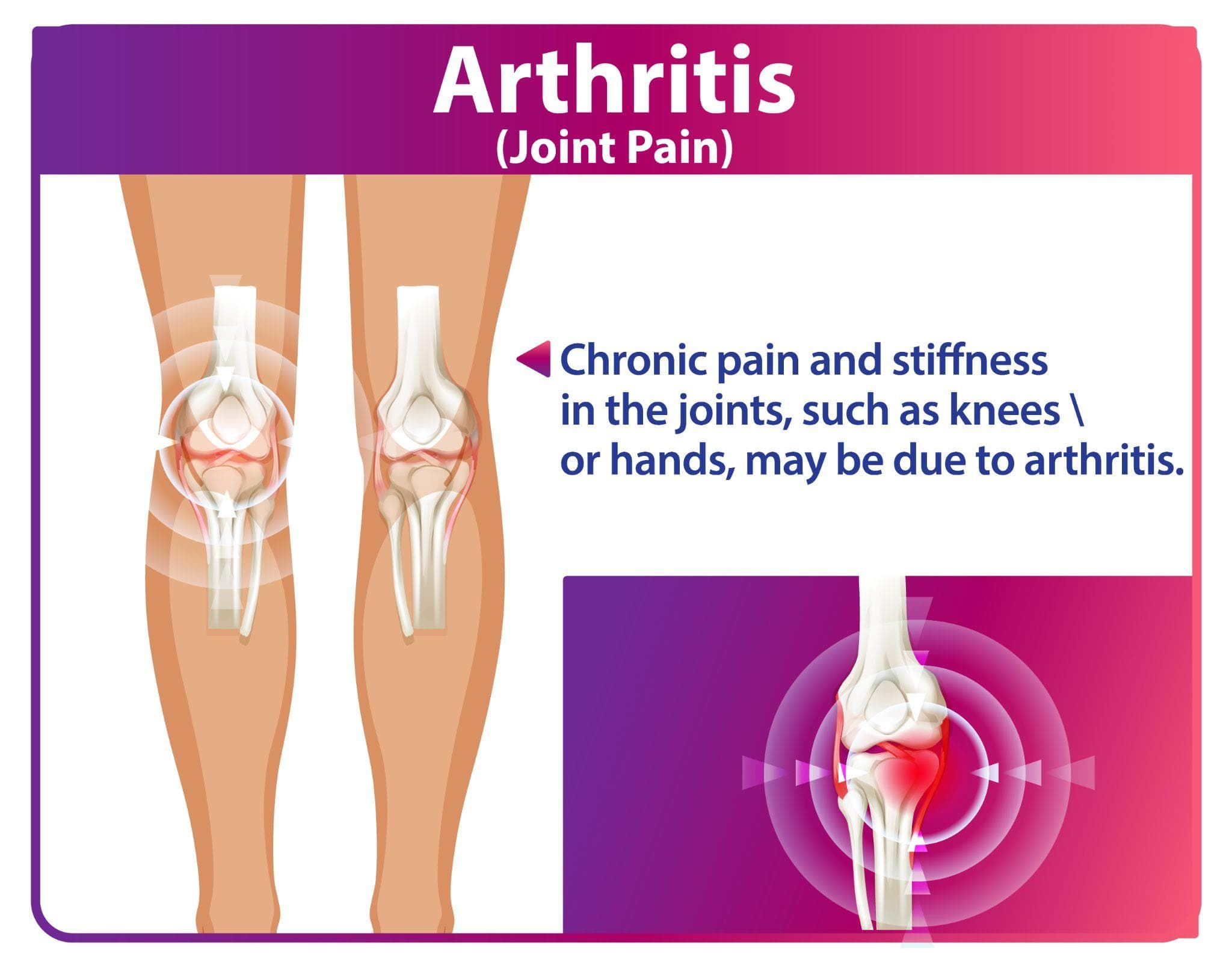 गठिया (Arthritis) के शुरुआती लक्षण कैसे पहचानें?