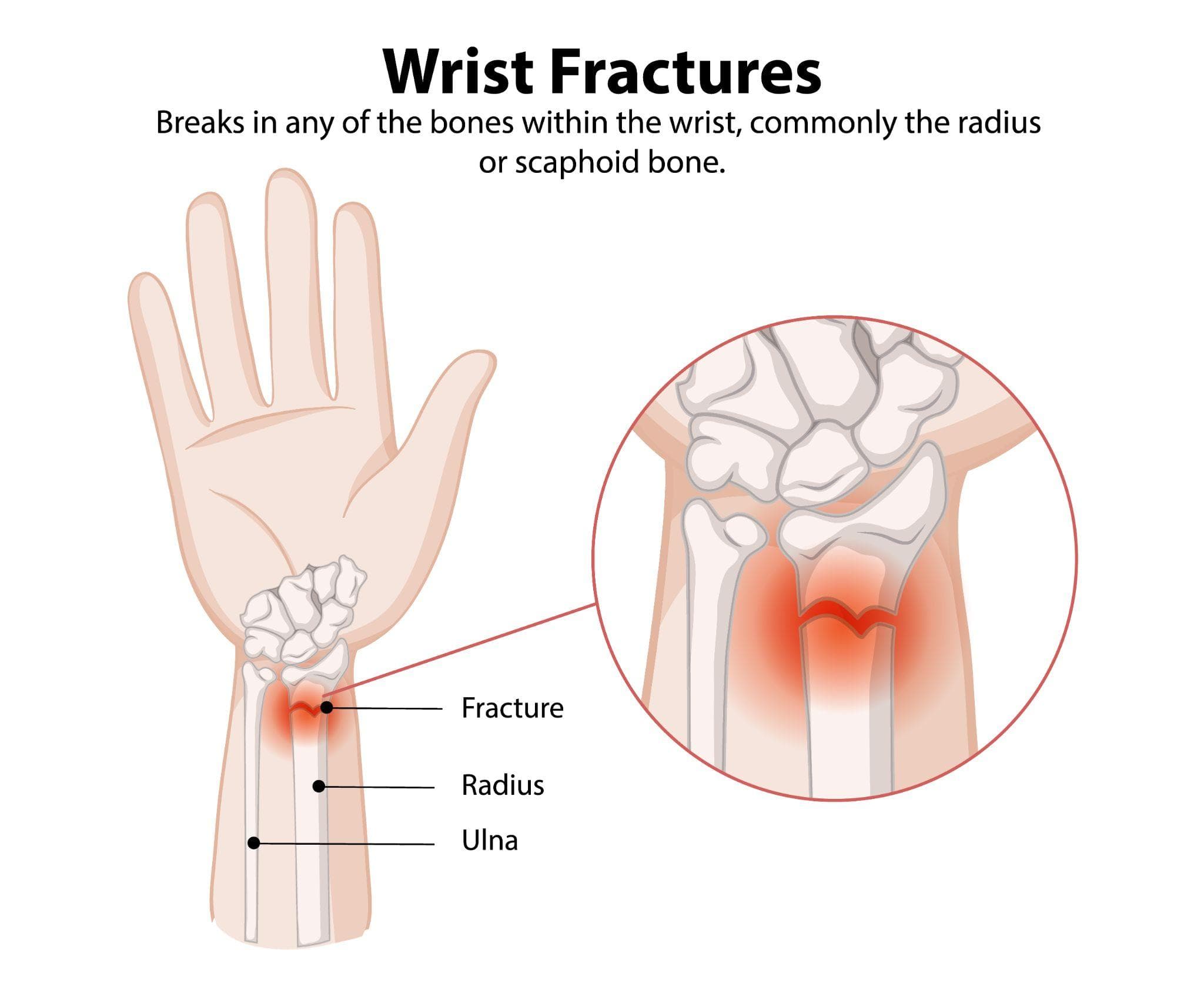 Wrist Fracture (Colles Fracture) - Causes, Treatment, And Recovery