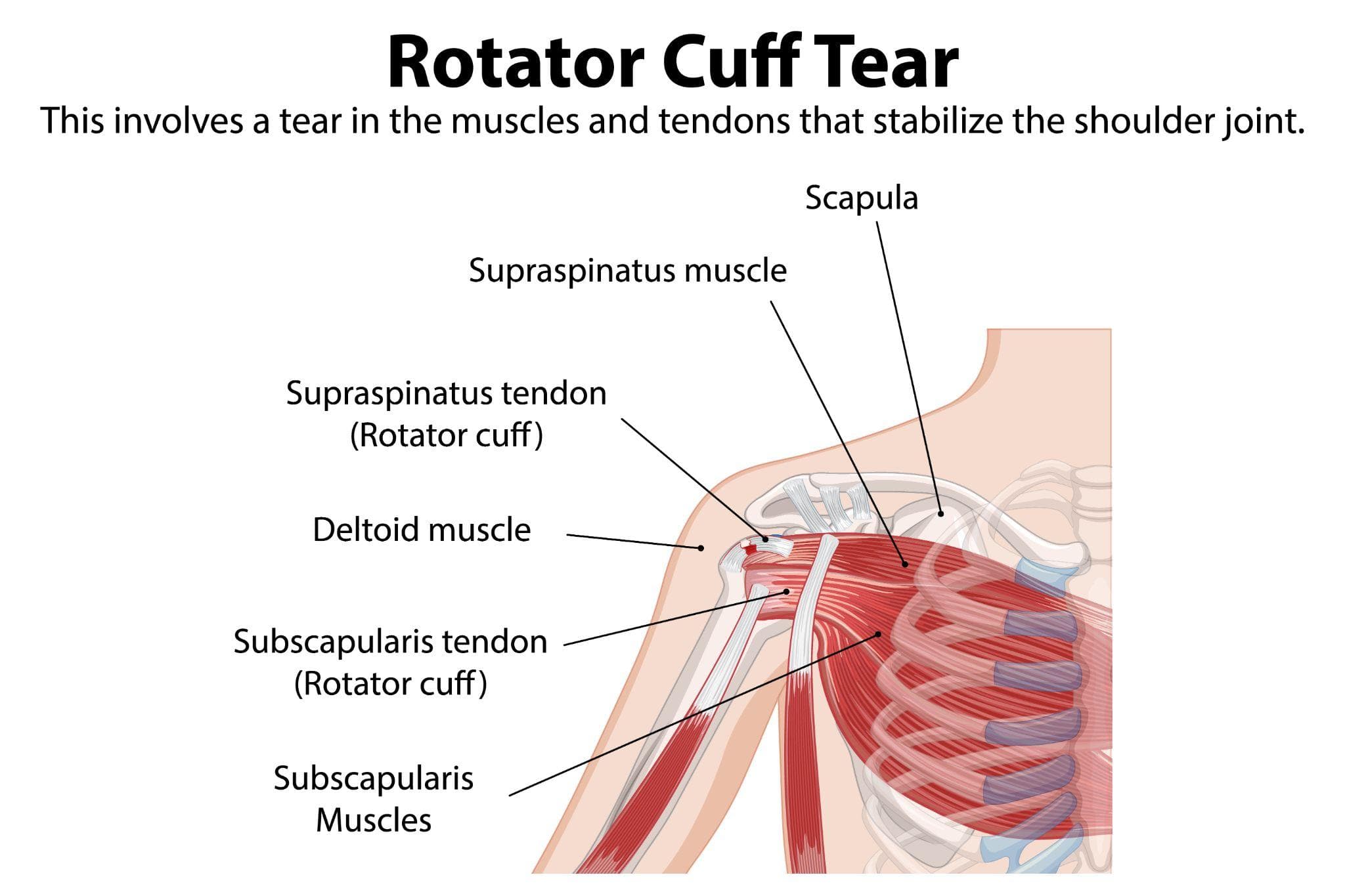 Reverse Shoulder Replacement For Rotator Cuff Tears