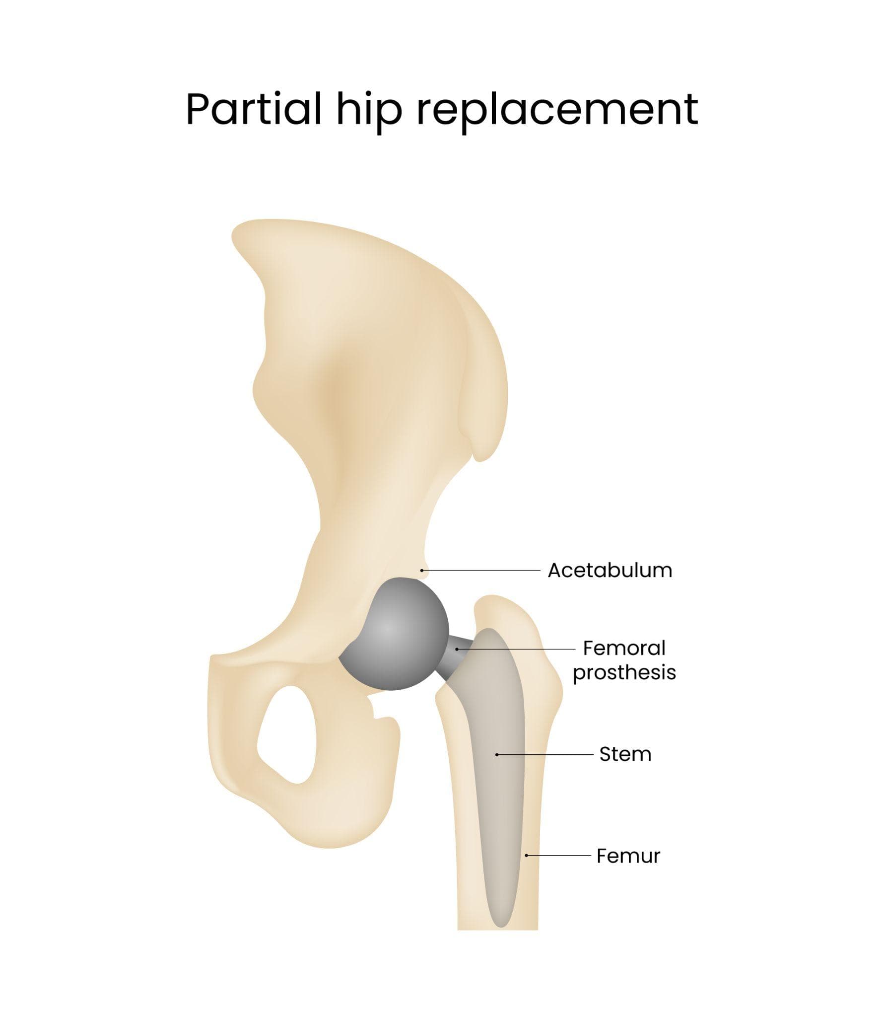 An anatomy showcasing the partial hip replacement and labelling is shown of it and of the surrounding parts.