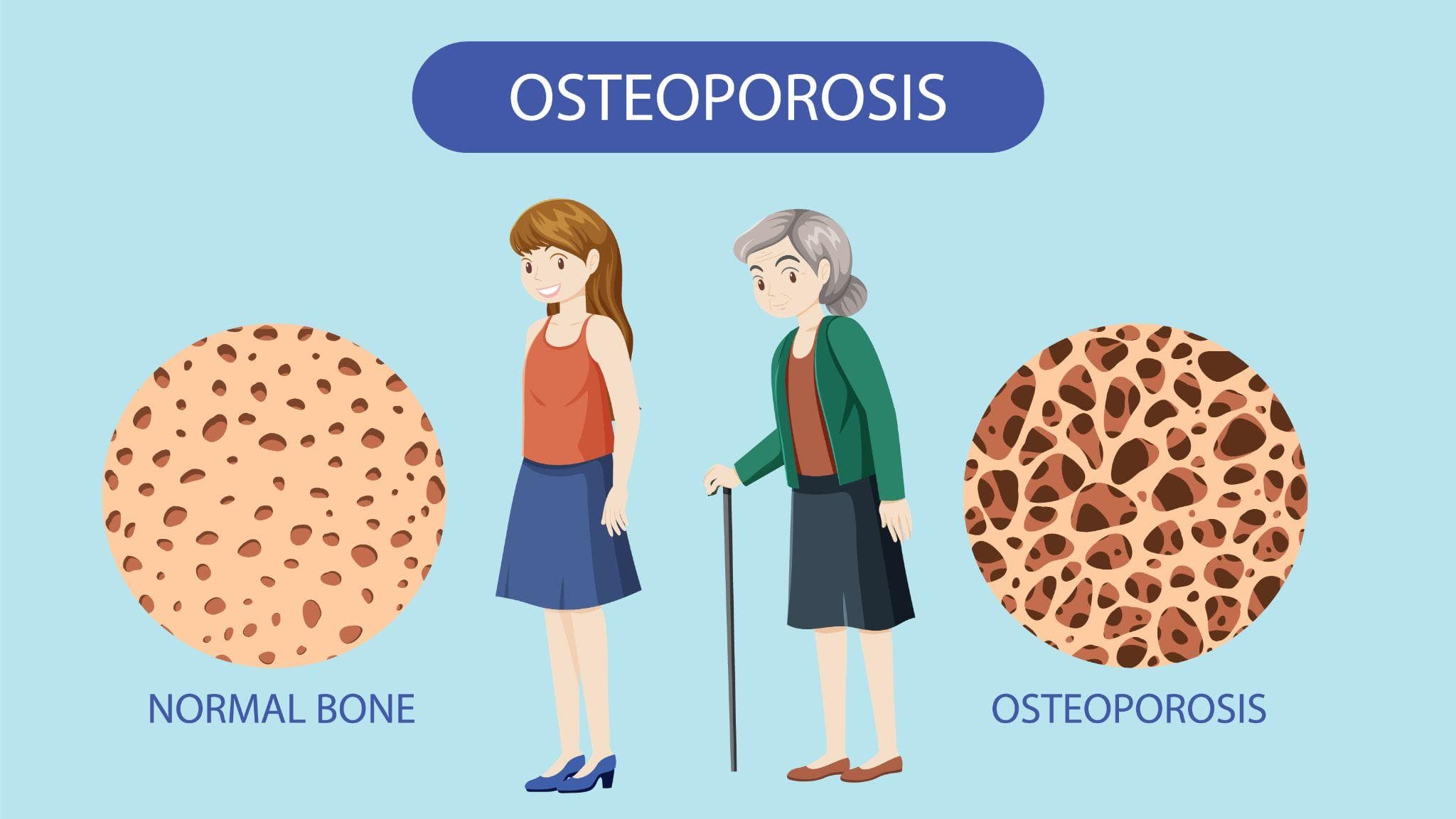 An illustration showcasing two women of young and old age in comparison, as one has normal bones and the older one has osteoporosis.