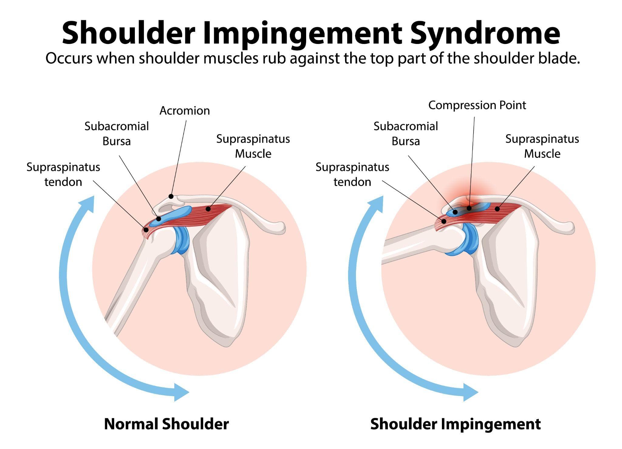 A Complete Guide To Shoulder Impingement