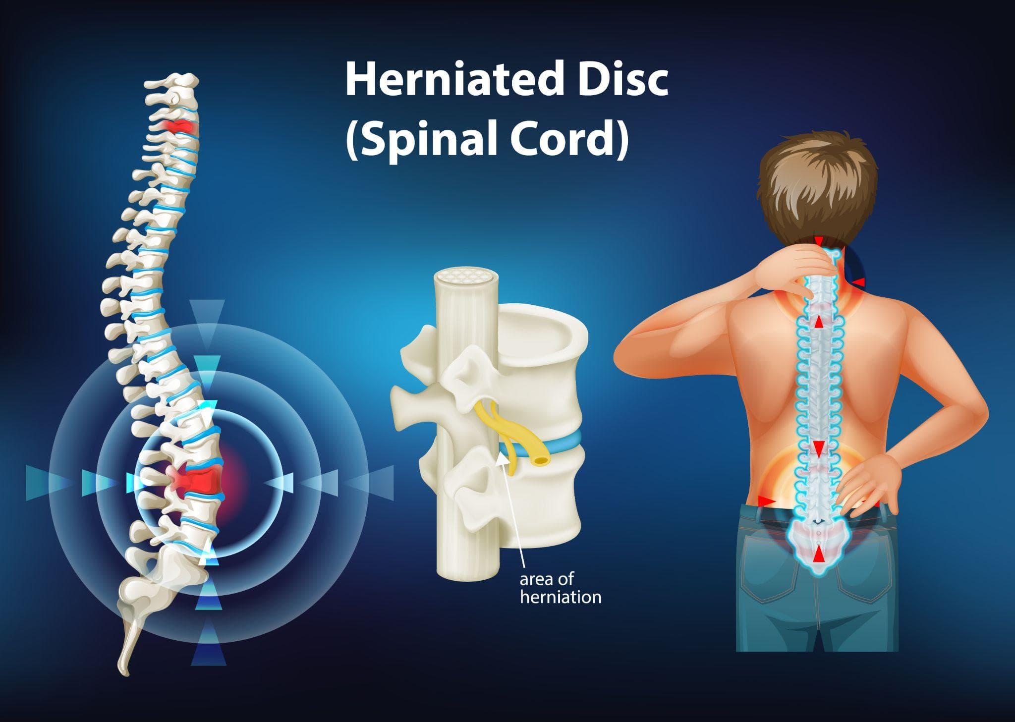 Medical illustration showing a herniated spinal disc pressing on a nerve, with some diagrams of a human body showing the spine and areas of pain in the back.
