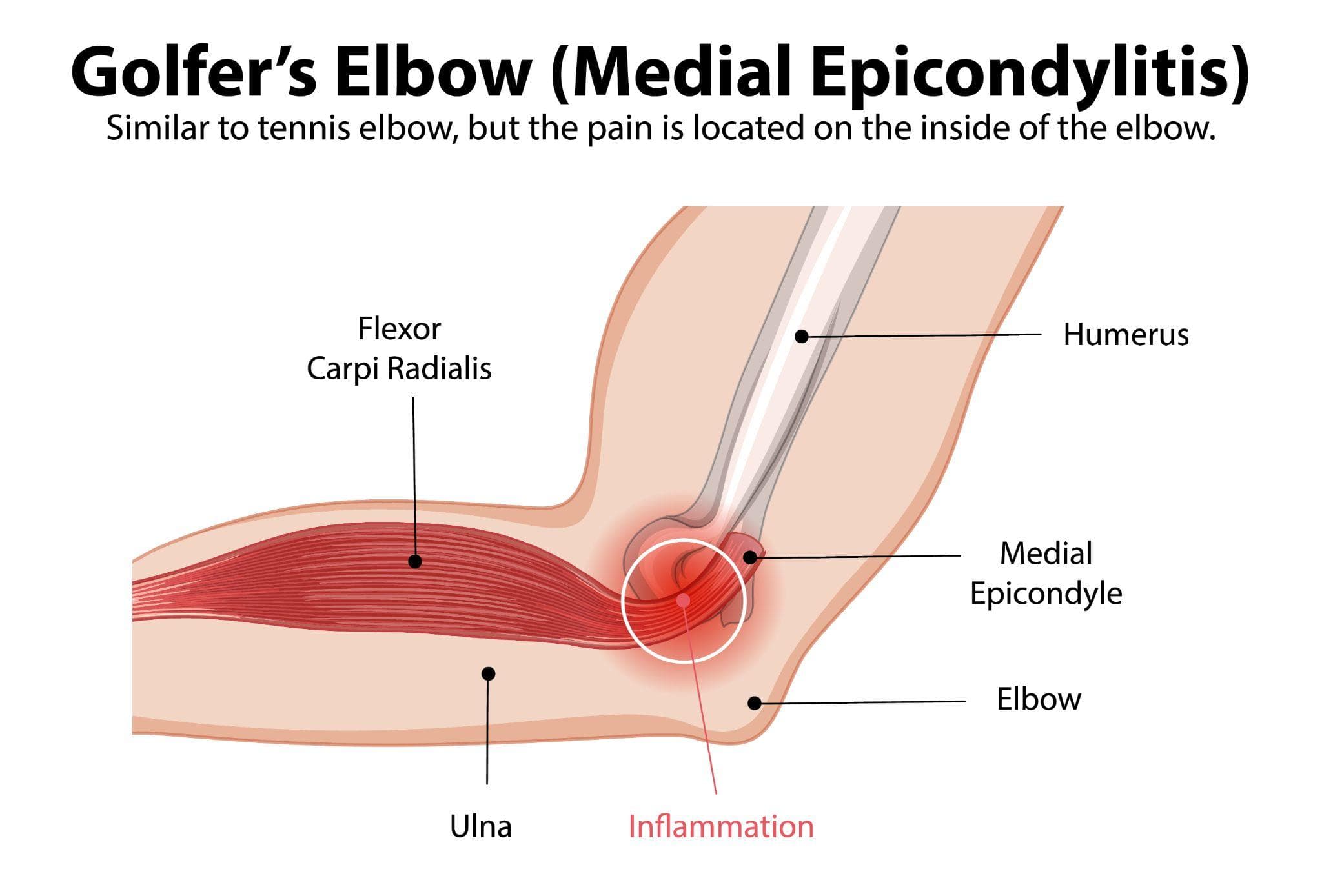 Tennis Elbow Vs Golfer’s Elbow: Key Differences
