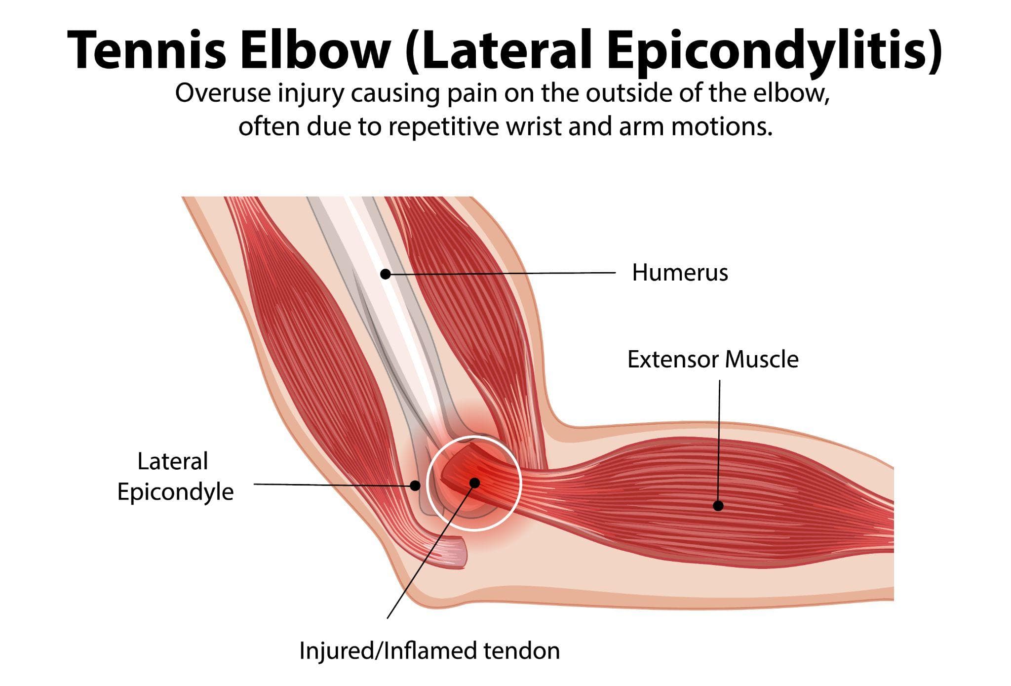 Anatomical diagram of tennis elbow (lateral epicondylitis) showing the outer elbow area with labels for the humerus, lateral epicondyle, extensor muscles, and a damaged tendon.