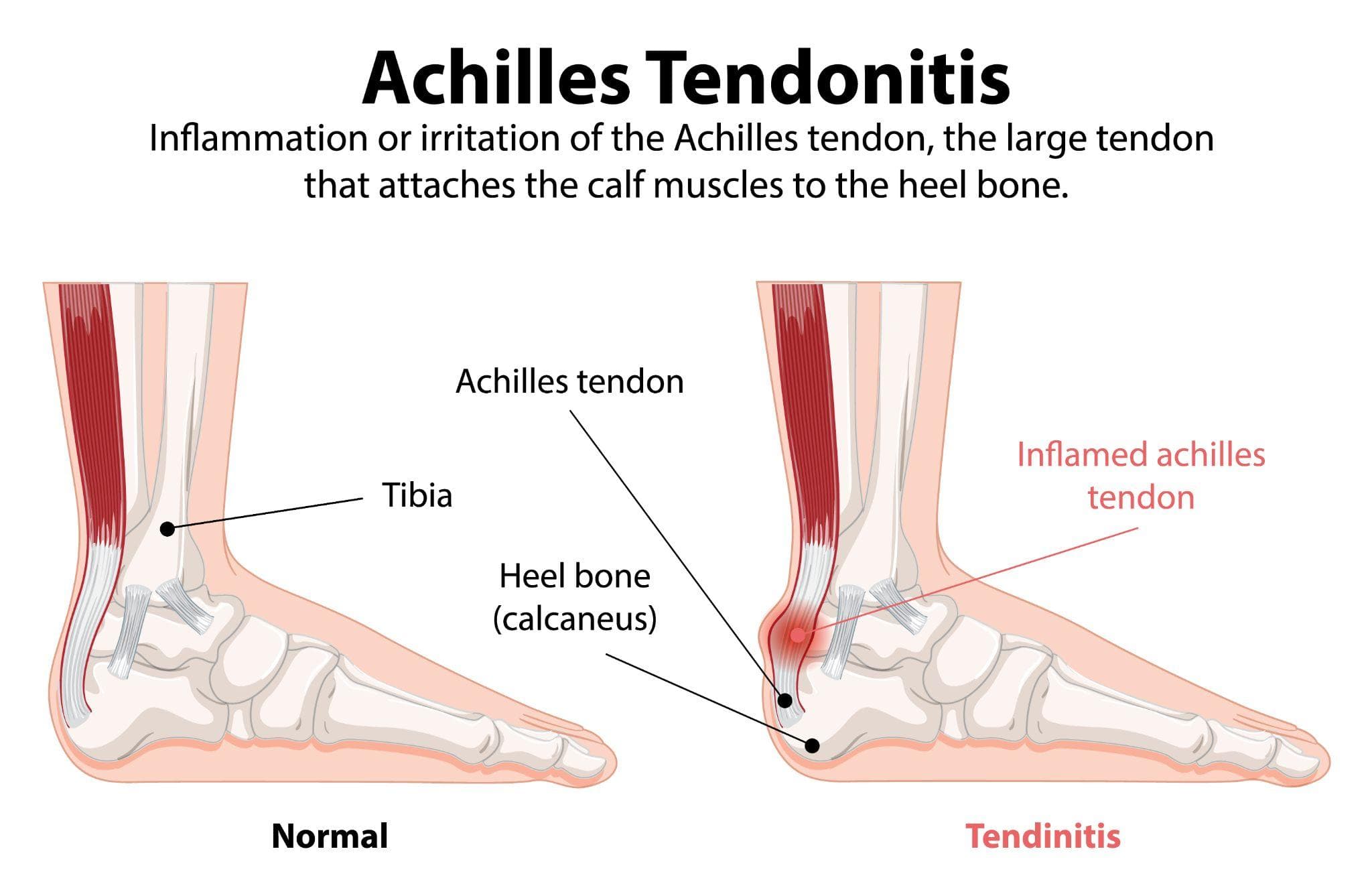 Achilles Tendon Injury: Causes, Symptoms & Treatment