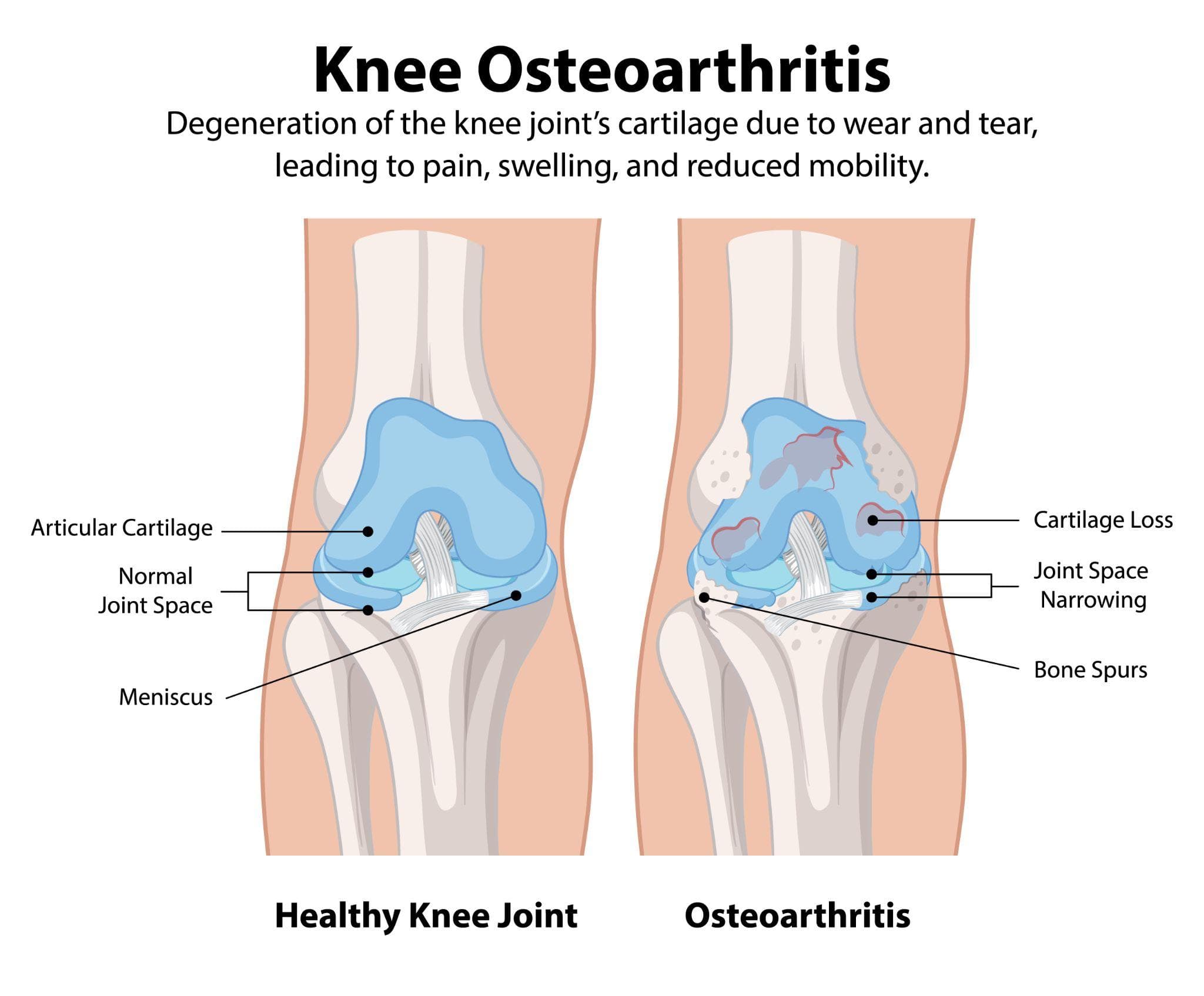 An educational illustration showing the comparison of a healthy knee joint and a knee joint impacted by the condition osteoarthritis. The left shows a healthy knee, including labels to signify the articular cartilage, the regular joint space, and the meniscus. In contrast, the right section displays the deterioration that has occurred in the condition, focusing on the absence of cartilage, a narrowed joint space, and bone growths (spurs).