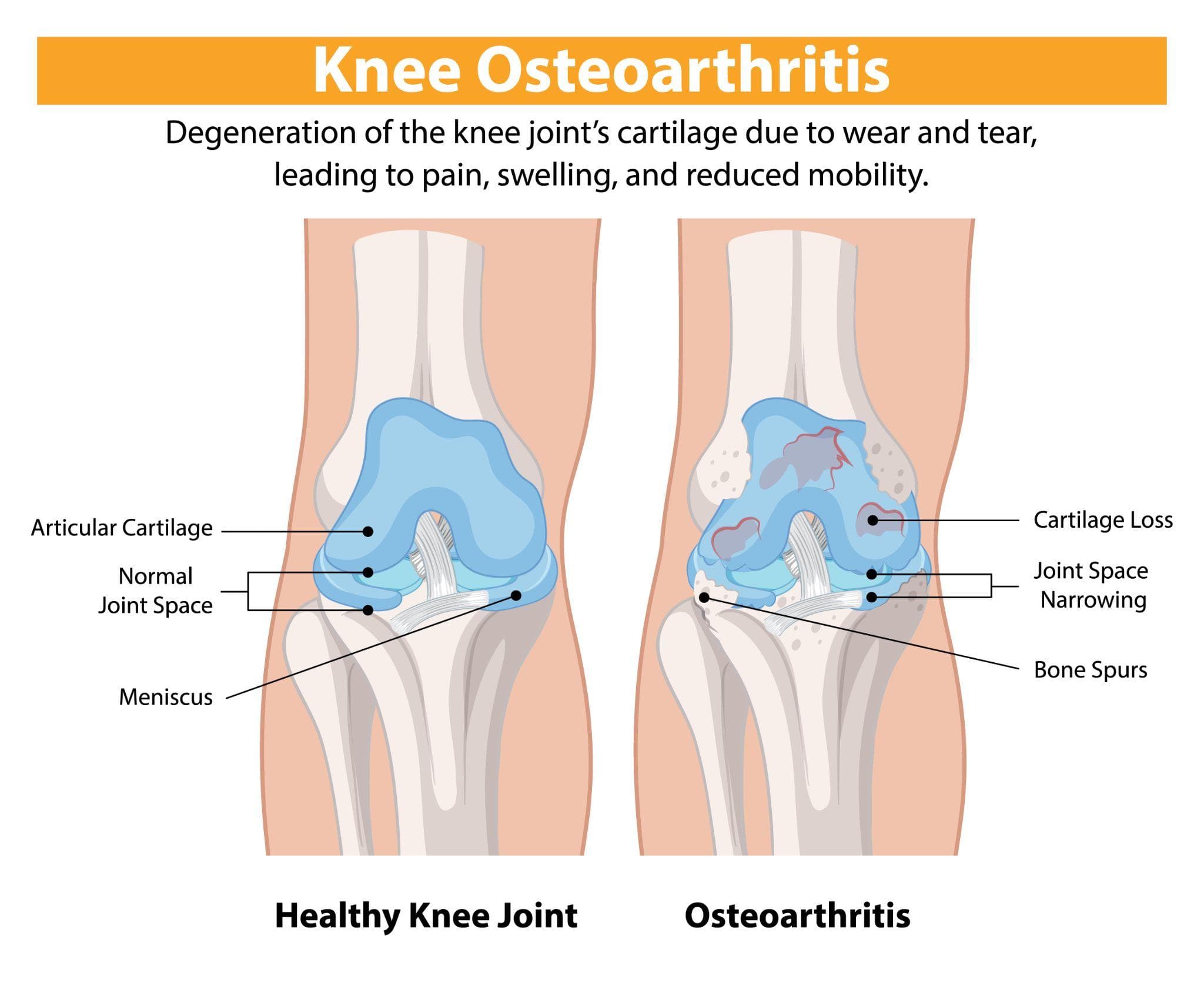 Medical drawing of a normal knee joint compared with a knee joint with osteoarthritis. The diseased drawing illustrates cartilage erosion, narrowing of the joint space, joint bone proliferation, and concavity of the menisci.