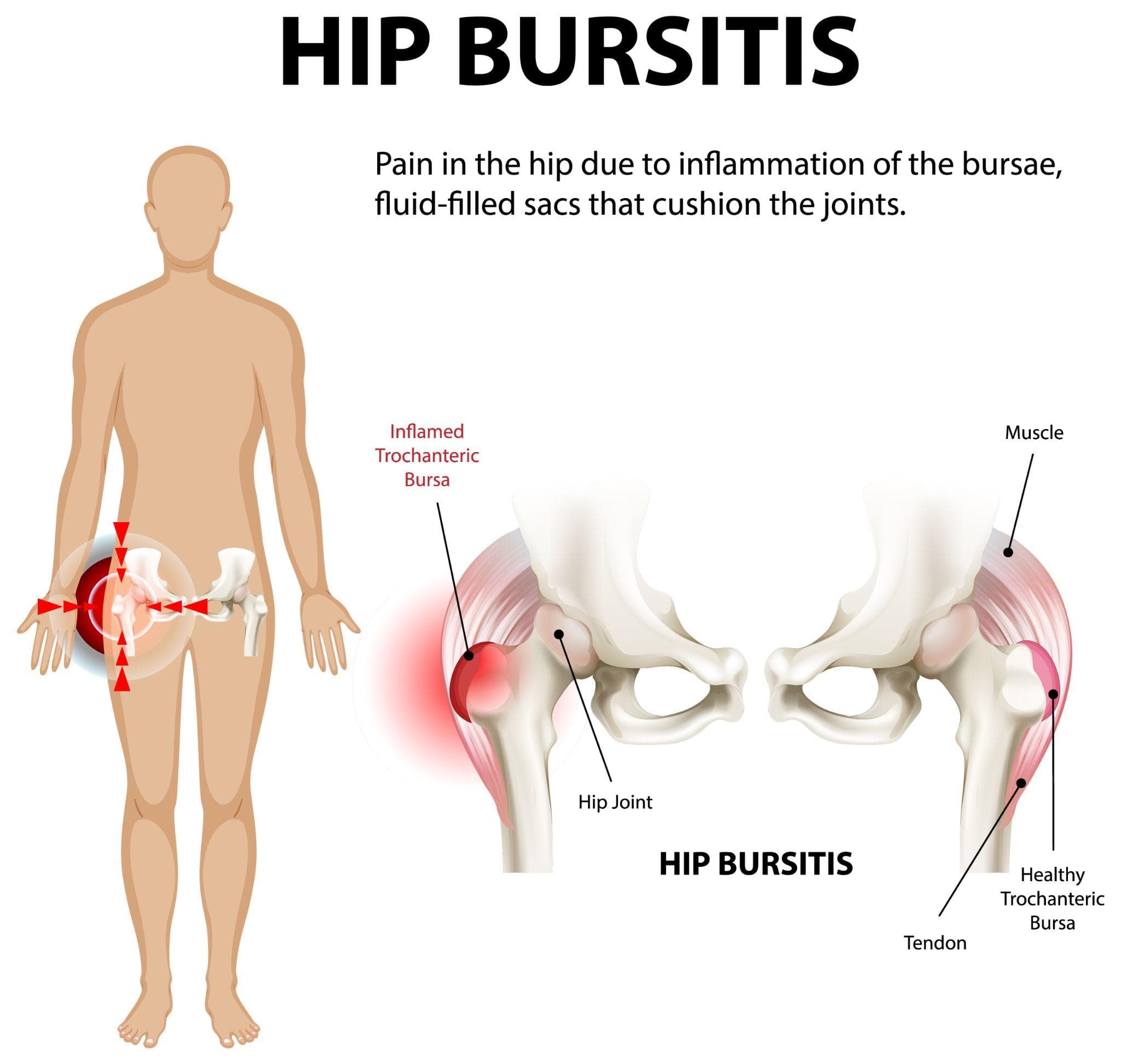 Hip Bursitis — Causes, Symptoms, and Treatment Without Surgery