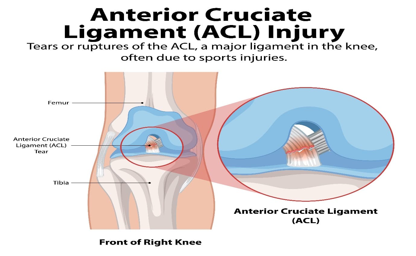Life After ACL Surgery - Return to Sport, Recovery Milestones and Long-Term Knee Health