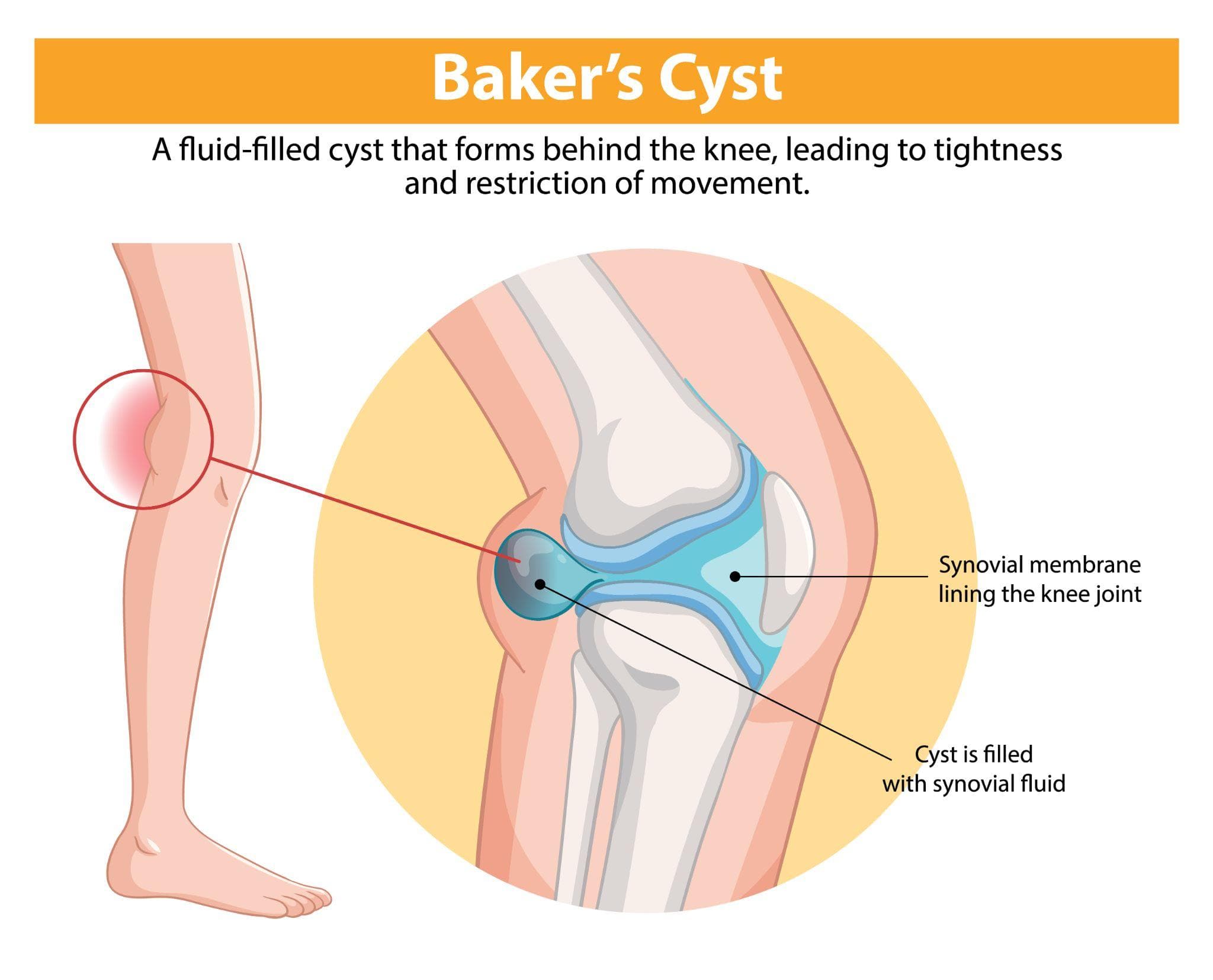 Baker’s Cyst Symptoms: When Should You Worry?
