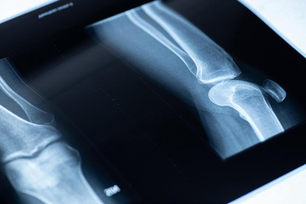 An X-ray of the knee joint is taken and kept against a white background.