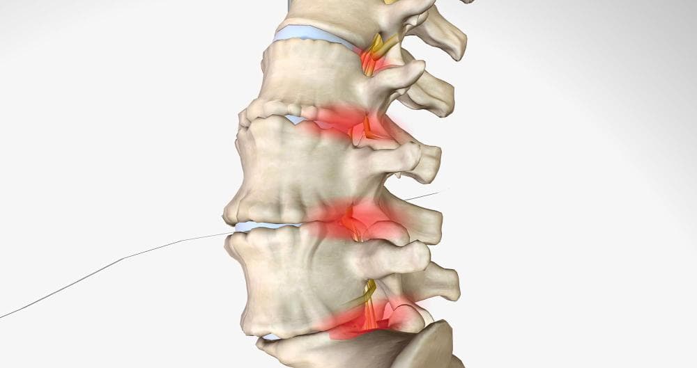Degenerative Disc Disease: What You Need To Know