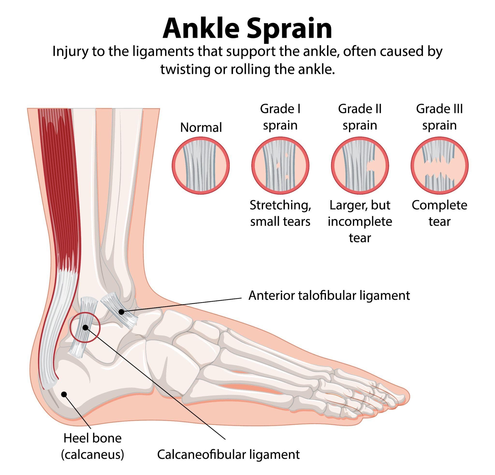 Ankle Sprain: Grades, Treatment, And Recovery Time