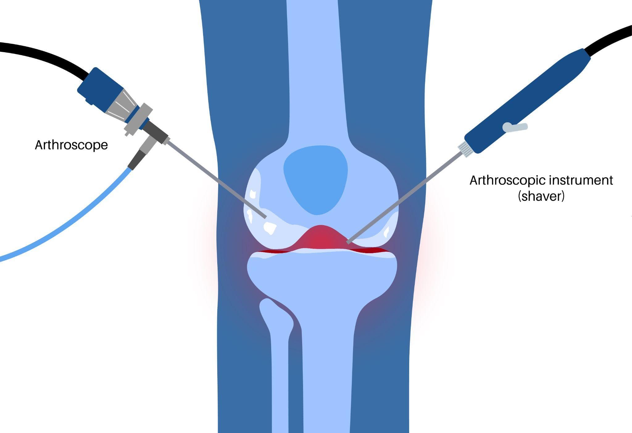 Medical illustration of knee arthroscopy procedure showing an arthroscope and surgical shaver inserted into the knee joint to treat damaged cartilage and inflamed tissue in post-traumatic arthritis.
