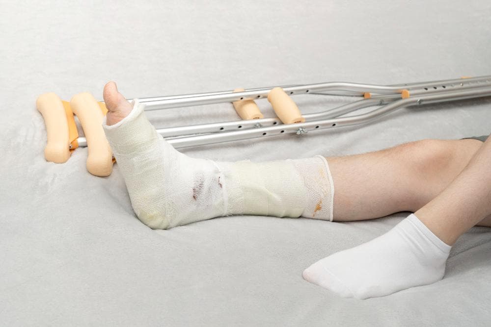 A close-up shot of a fractured leg placed on a bed with clutches lying beside, and the leg has a cast on it.