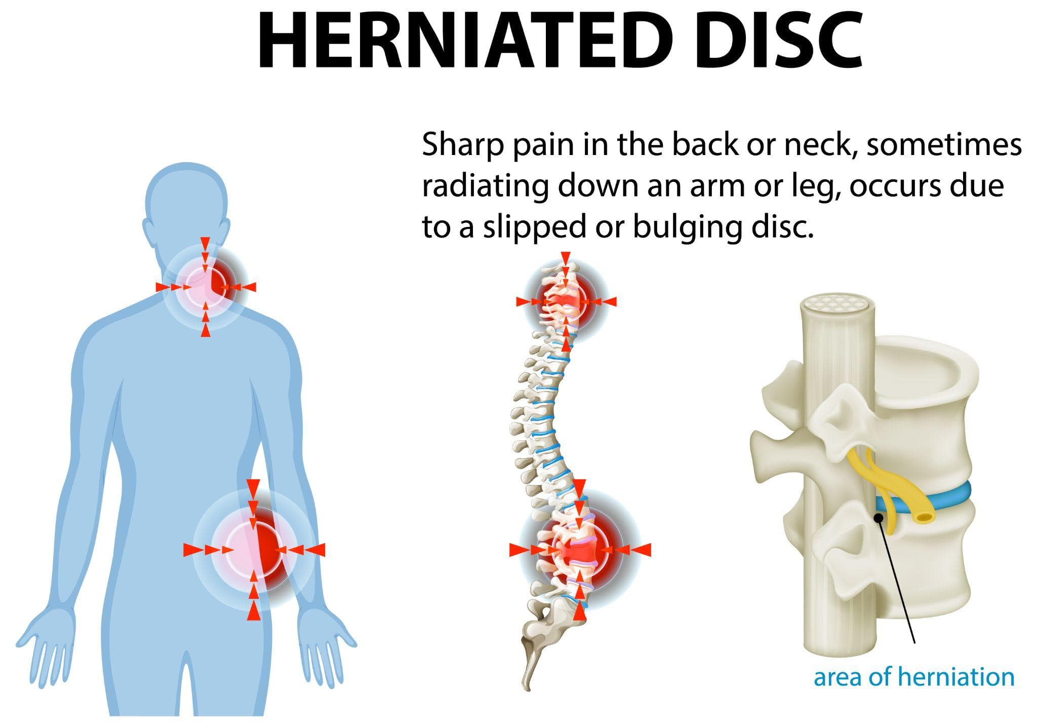 Medical illustration of a herniated disc showing pain points in the neck and lower back with highlighted nerve compression and affected spinal areas.