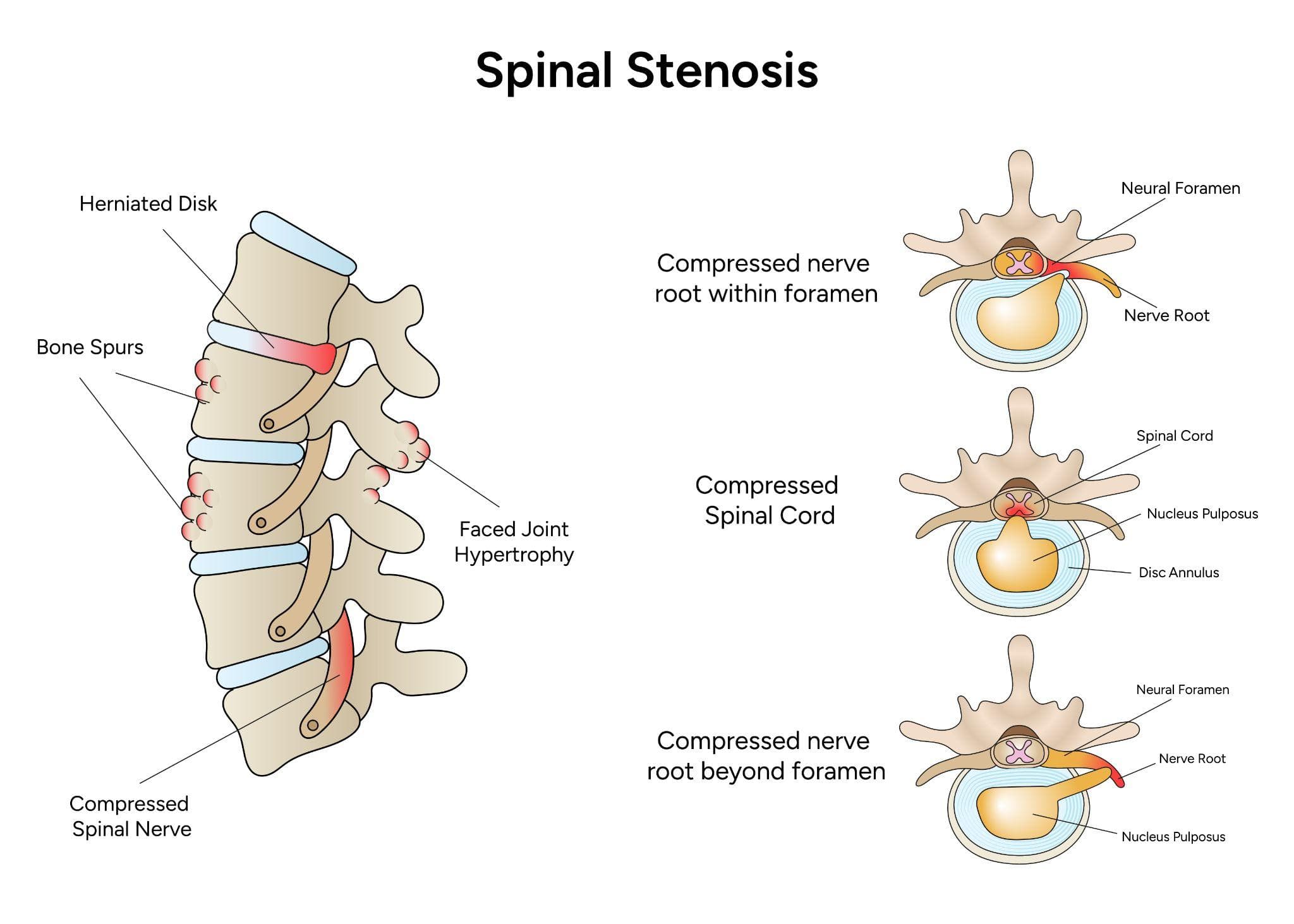 An anatomical illustration labeled Spinal Stenosis provides a visual overview of the spine's structural issues.