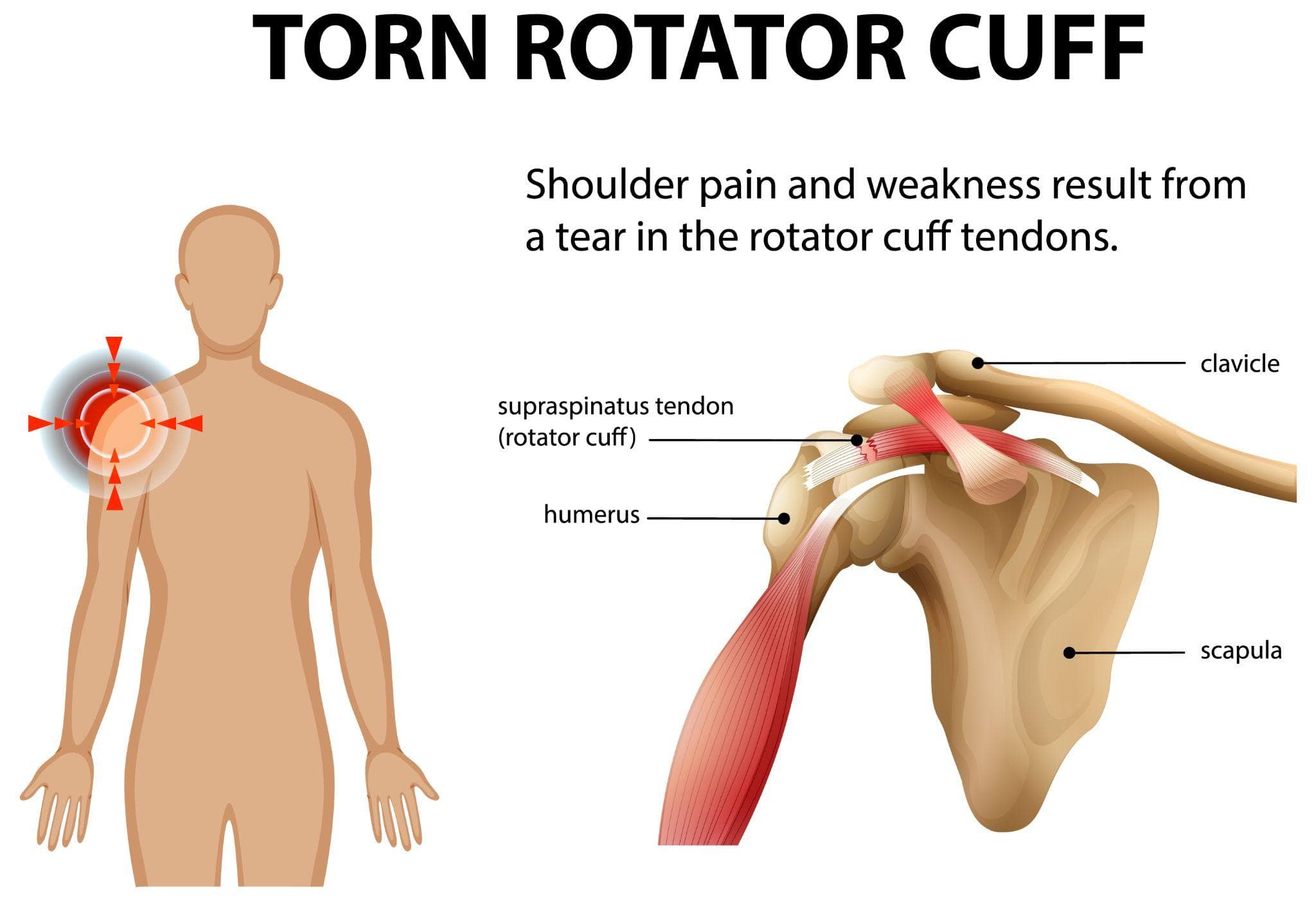 An anatomical illustration of the Torn Rotator Cuff features a diagram of a human shoulder. It shows the shoulder joint with clear labels. An accompanying depiction of a human figure on the left illustrates the area of pain.