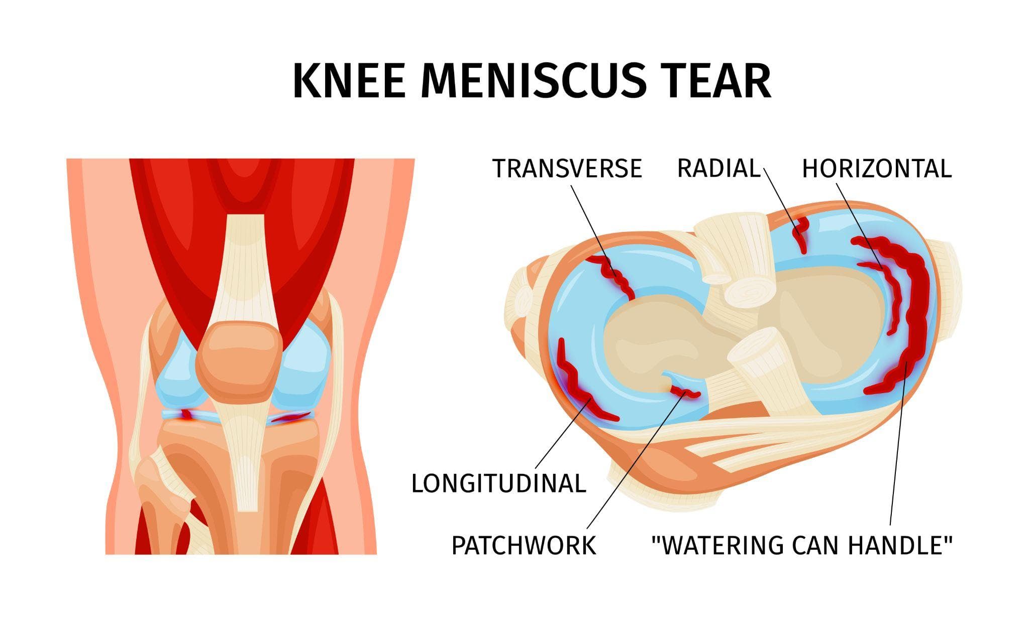 Meniscus Tear - What It Is, How It Happens, and When You Need Surgery