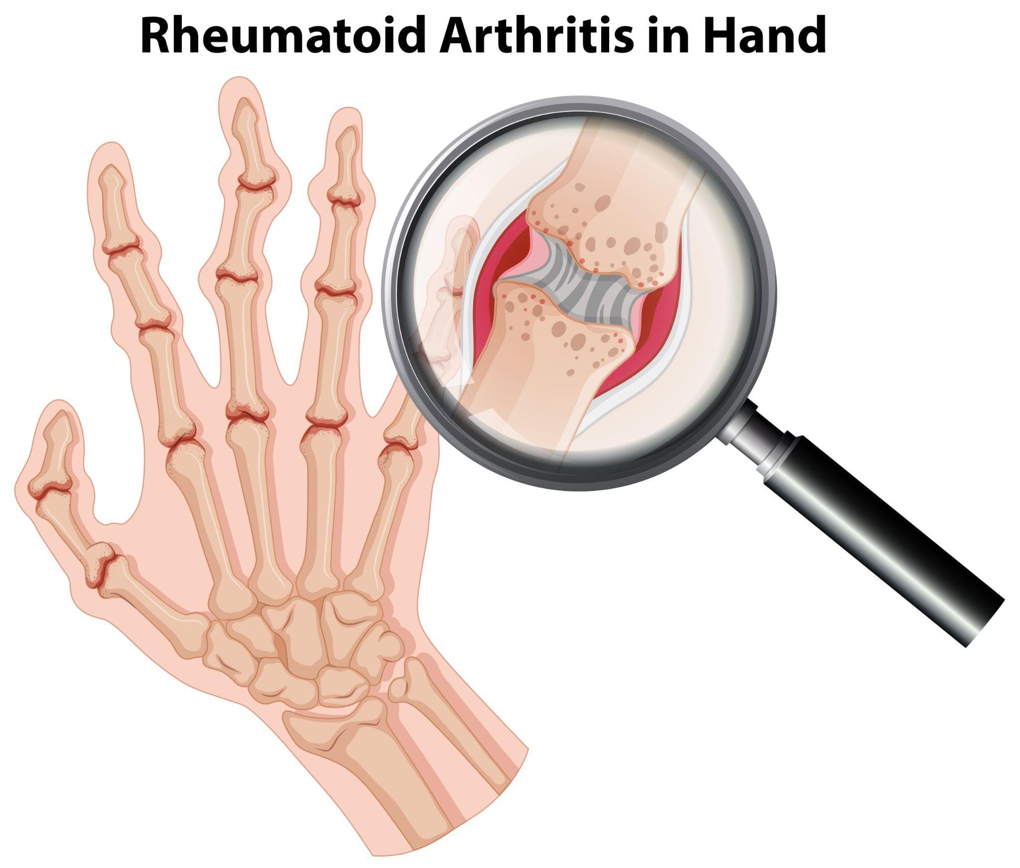 Rheumatoid Arthritis: The Hidden Cause Of Joint Pain And Stiffness