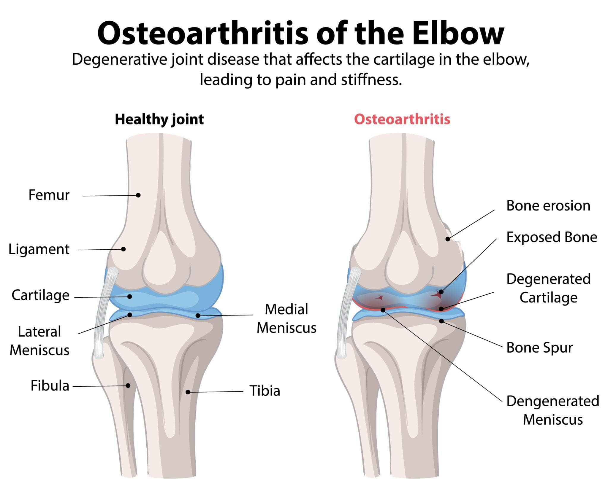 An informative diagram illustrates "Osteoarthritis of the Elbow." The left side shows a healthy elbow joint with clearly labeled components, while the right side details the effects of osteoarthritis, including bone erosion and degenerated cartilage.