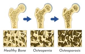 A visual representation of a bone developing Tumor.